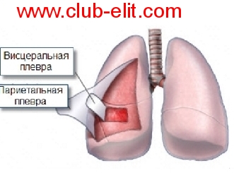 1 Plevrit